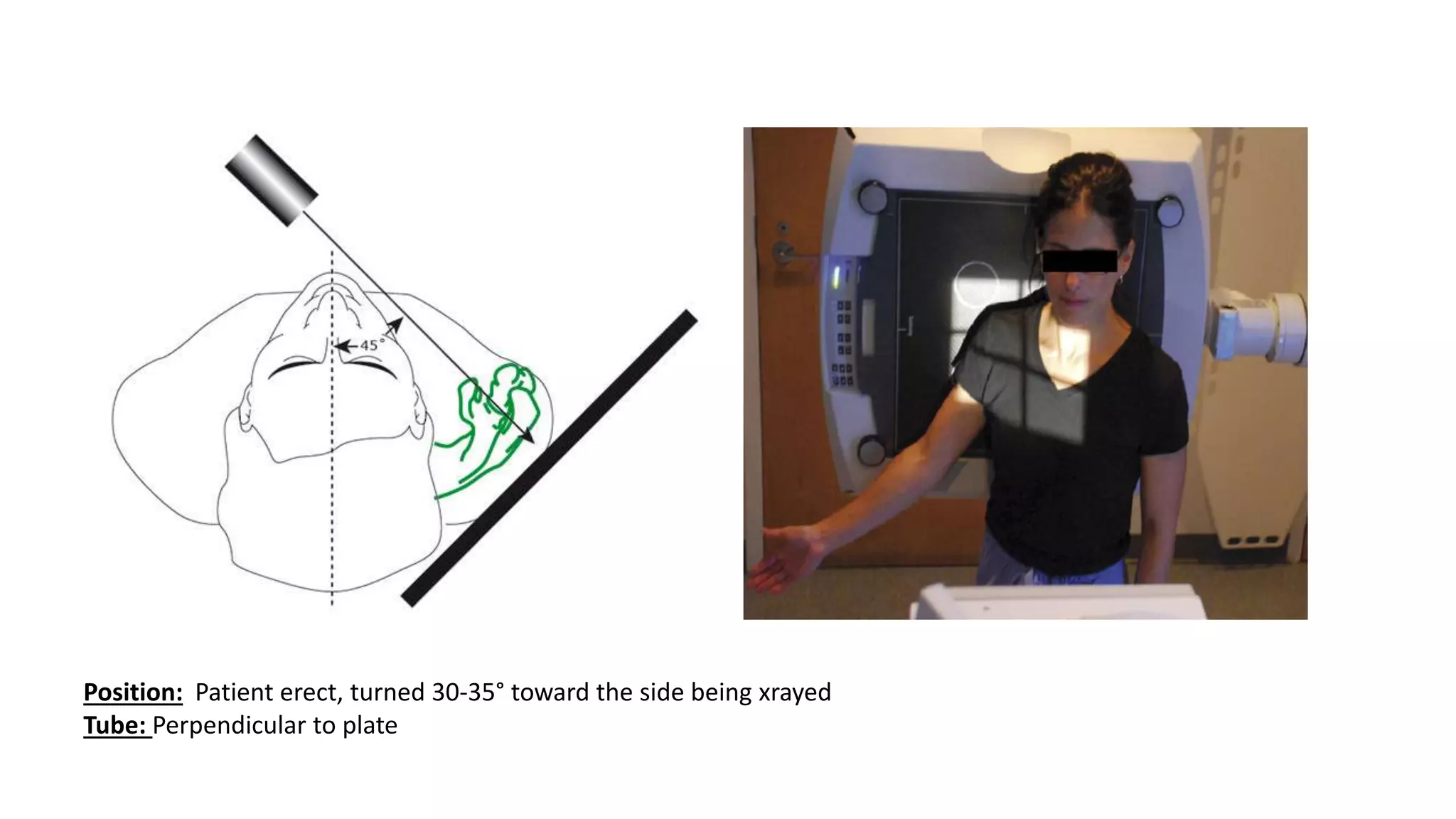 Position: Patient erect, turned 30-35° toward the side being xrayed
Tube: Perpendicular to plate
 