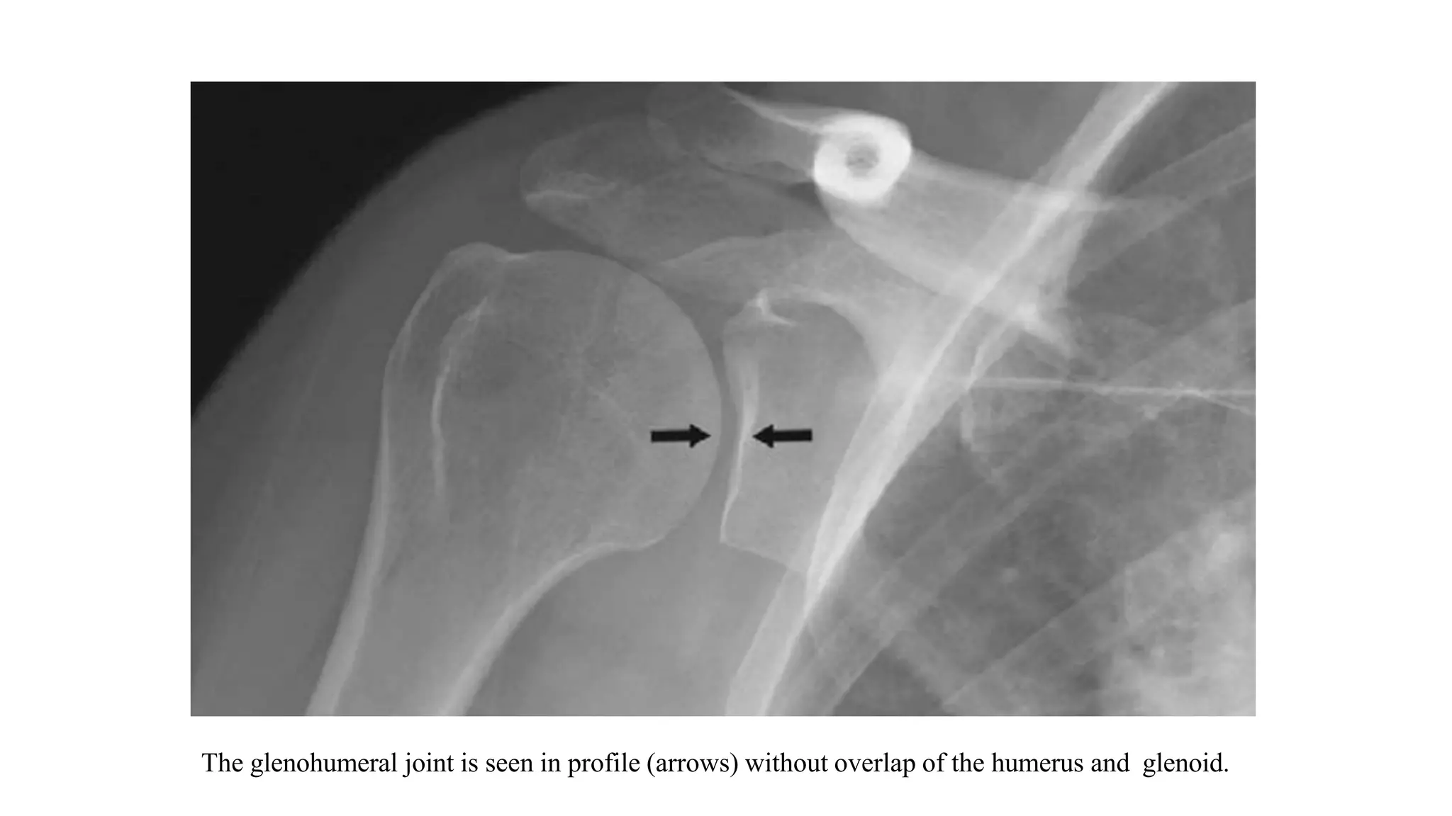 The glenohumeral joint is seen in profile (arrows) without overlap of the humerus and glenoid.
 
