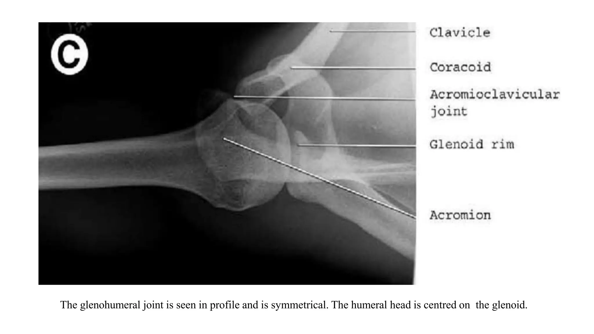 The glenohumeral joint is seen in profile and is symmetrical. The humeral head is centred on the glenoid.
 