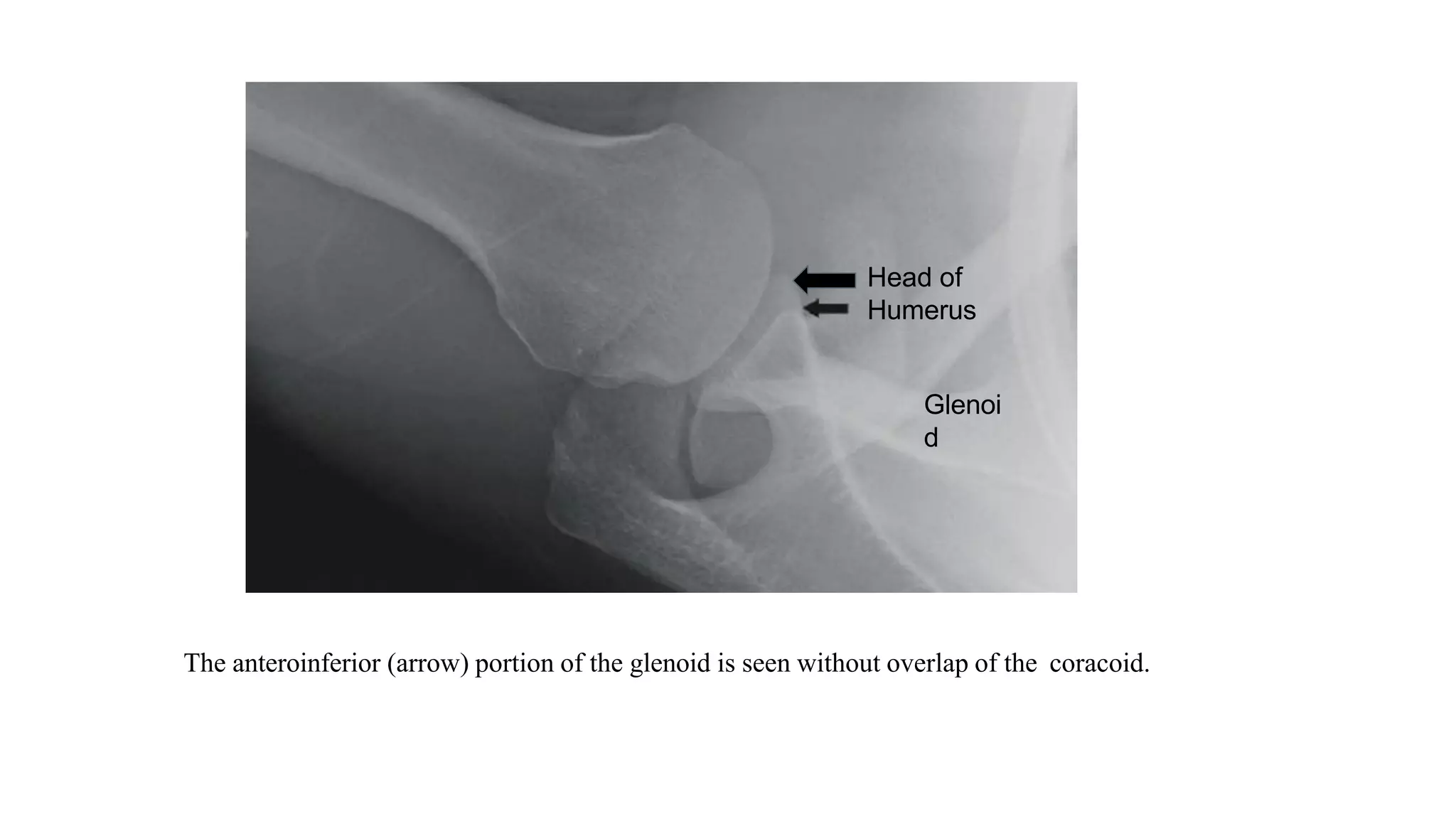 The anteroinferior (arrow) portion of the glenoid is seen without overlap of the coracoid.
Glenoi
d
Head of
Humerus
 