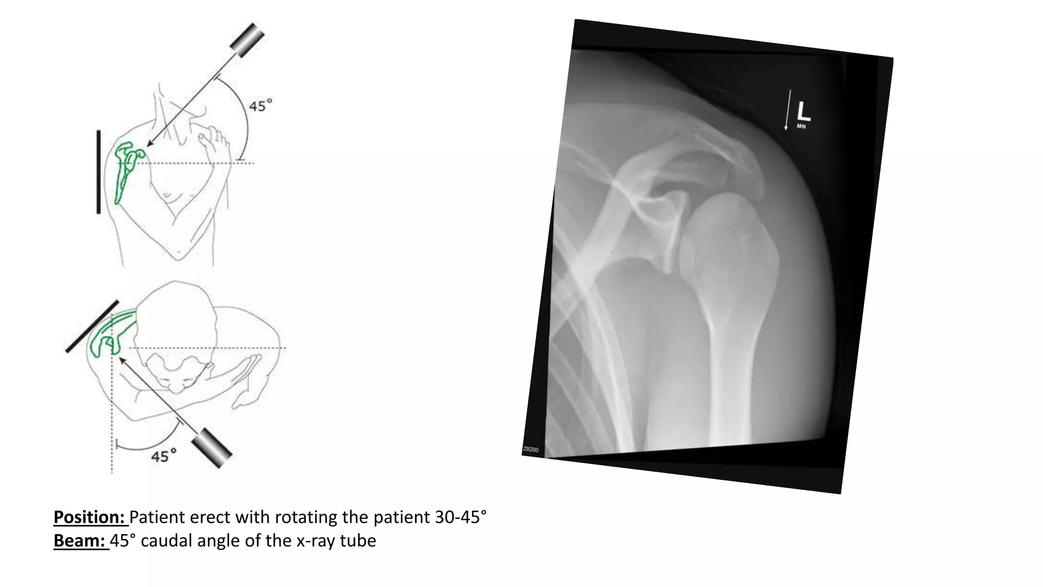 Position: Patient erect with rotating the patient 30-45°
Beam: 45° caudal angle of the x-ray tube
 