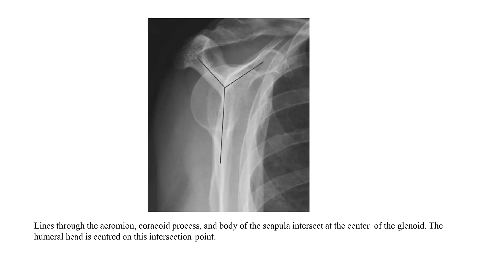 Lines through the acromion, coracoid process, and body of the scapula intersect at the center of the glenoid. The
humeral head is centred on this intersection point.
 