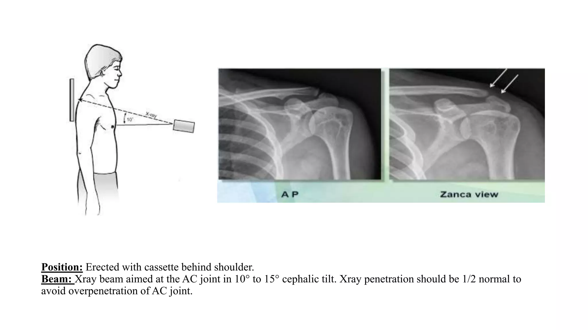 Position: Erected with cassette behind shoulder.
Beam: Xray beam aimed at the AC joint in 10° to 15° cephalic tilt. Xray penetration should be 1/2 normal to
avoid overpenetration of AC joint.
 