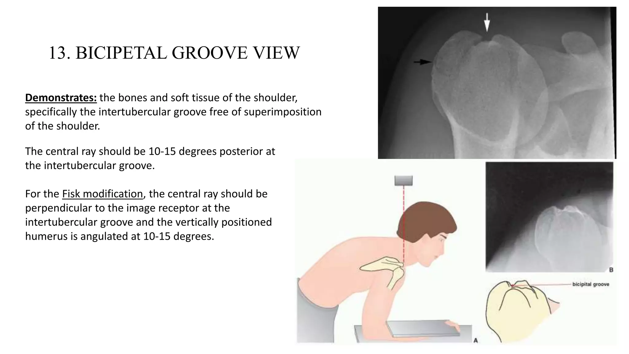 13. BICIPETAL GROOVE VIEW
Demonstrates: the bones and soft tissue of the shoulder,
specifically the intertubercular groove free of superimposition
of the shoulder.
The central ray should be 10-15 degrees posterior at
the intertubercular groove.
For the Fisk modification, the central ray should be
perpendicular to the image receptor at the
intertubercular groove and the vertically positioned
humerus is angulated at 10-15 degrees.
 