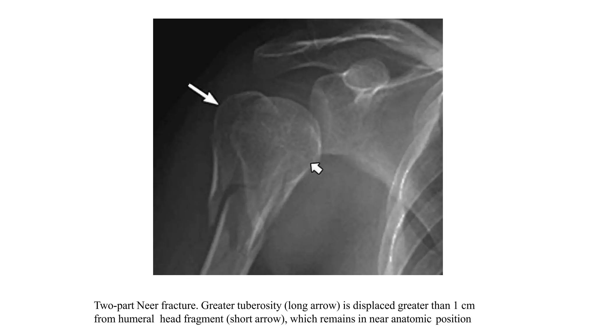 Two-part Neer fracture. Greater tuberosity (long arrow) is displaced greater than 1 cm
from humeral head fragment (short arrow), which remains in near anatomic position
 
