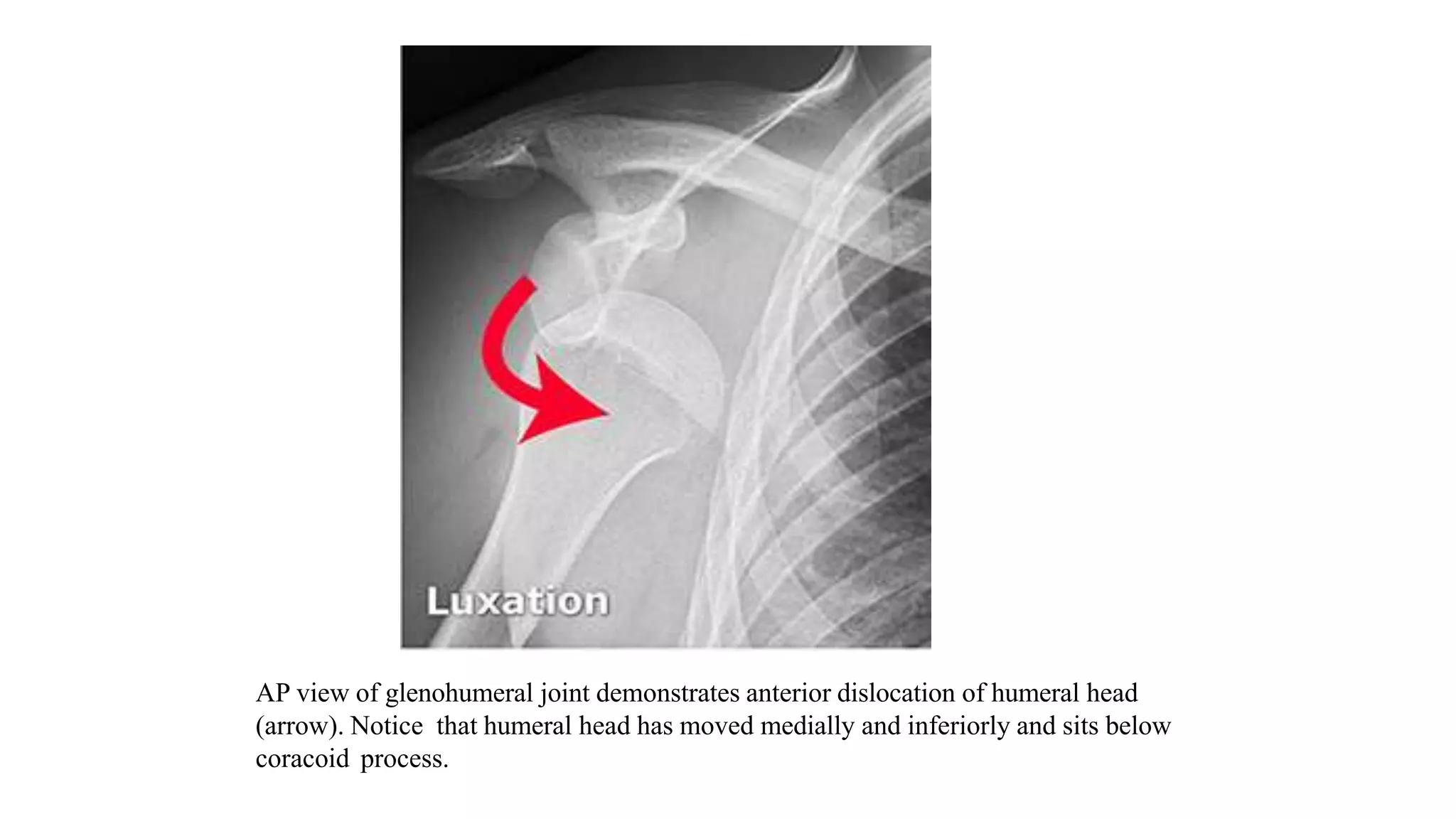 AP view of glenohumeral joint demonstrates anterior dislocation of humeral head
(arrow). Notice that humeral head has moved medially and inferiorly and sits below
coracoid process.
 
