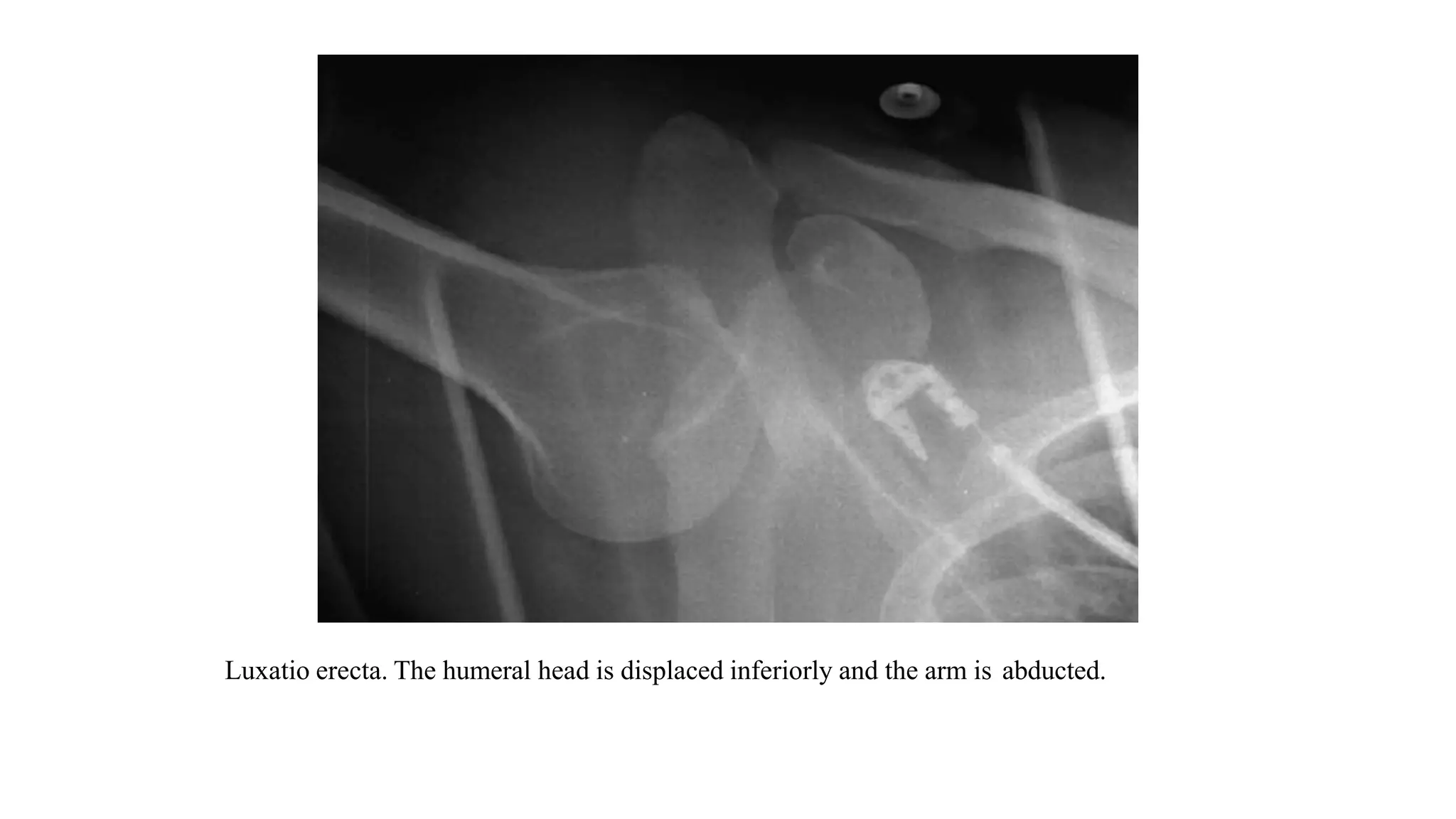 Luxatio erecta. The humeral head is displaced inferiorly and the arm is abducted.
 