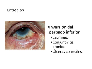 Entropion
•Inversión del
párpado inferior
•Lagrimeo
•Conjuntivitis
crónica
•Úlceras corneales
 