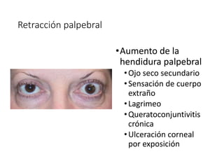 Retracción palpebral
•Aumento de la
hendidura palpebral
•Ojo seco secundario
•Sensación de cuerpo
extraño
•Lagrimeo
•Queratoconjuntivitis
crónica
•Ulceración corneal
por exposición
 