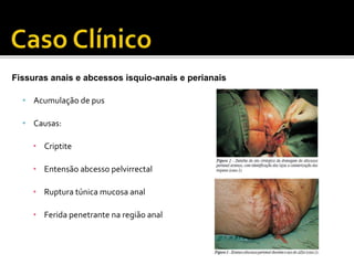 Fissuras anais e abcessos isquio-anais e perianais 
• Acumulação de pus 
• Causas: 
• Criptite 
• Entensão abcesso pelvirrectal 
• Ruptura túnica mucosa anal 
• Ferida penetrante na região anal 
 