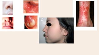ANCA associated vasculitis.pdf////////// | PDF