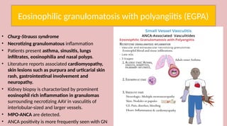anca vasculitis in pediaric pts .pptx