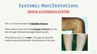 ANCA Vasculitis Management Guidelines Presentation | PDF