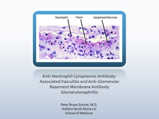 Anti-Neutrophil Cytoplasmic Antibody-Associated Vasculitis and Anti-Glomerular Basement Membrane Antibody Glomerulonephritis Peter Bryan Schrier, M.D. Hofstra North Shore LIJ School of Medicine 
