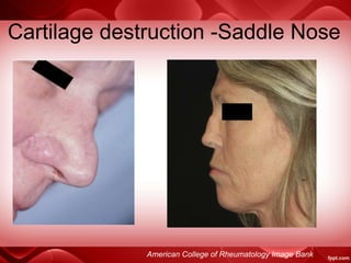 Cartilage destruction -Saddle Nose
American College of Rheumatology Image Bank
 