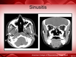 Sinusitis
American College of Rheumatology Image Bank
 