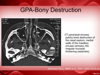 GPA-Bony Destruction
Mohamed Haris, MBBS et al. CMAJ 2008;178:25-26
CT paranasal sinuses:
patchy bone destruction of
the nasal septum, medial
walls of the maxillary
sinuses (arrows); the
irregular mucosal
thickening (asterisks).
 