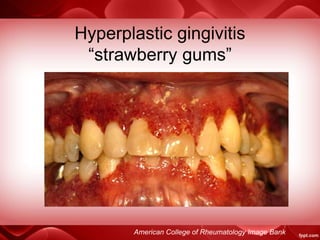 Hyperplastic gingivitis
“strawberry gums”
American College of Rheumatology Image Bank
 