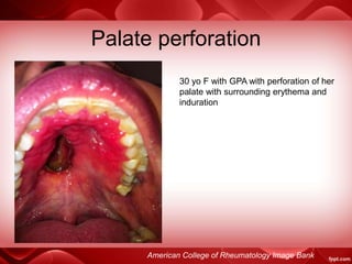 Palate perforation
30 yo F with GPA with perforation of her
palate with surrounding erythema and
induration
American College of Rheumatology Image Bank
 