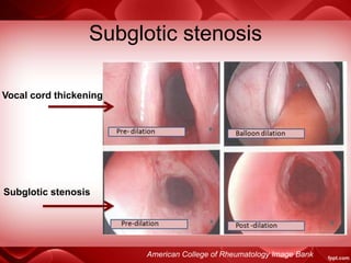 Subglotic stenosis
American College of Rheumatology Image Bank
Vocal cord thickening
Subglotic stenosis
 