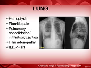 LUNG
Hemoptysis
Pleuritic pain
Pulmonary
consolidation/
infiltration, cavities
Hilar adenopathy
ILD/PHTN
American College of Rheumatology Image Bank
 