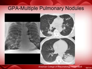GPA-Multiple Pulmonary Nodules
American College of Rheumatology Image Bank
 
