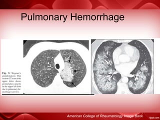 Pulmonary Hemorrhage
American College of Rheumatology Image Bank
 