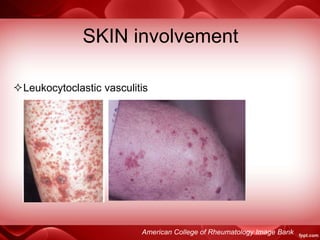 SKIN involvement
American College of Rheumatology Image Bank
Leukocytoclastic vasculitis
 
