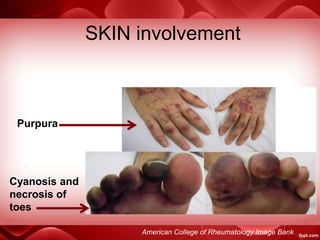 SKIN involvement
Purpura
Cyanosis and
necrosis of
toes
American College of Rheumatology Image Bank
 