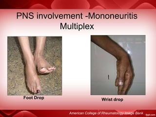 PNS involvement -Mononeuritis
Multiplex
American College of Rheumatology Image Bank
Foot Drop Wrist drop
 