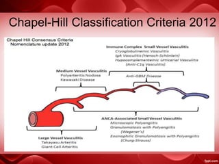 Chapel-Hill Classification Criteria 2012
 