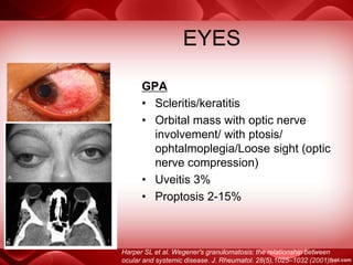 EYES
GPA
• Scleritis/keratitis
• Orbital mass with optic nerve
involvement/ with ptosis/
ophtalmoplegia/Loose sight (optic
nerve compression)
• Uveitis 3%
• Proptosis 2-15%
Harper SL et al. Wegener's granulomatosis: the relationship between
ocular and systemic disease. J. Rheumatol. 28(5),1025–1032 (2001).
 