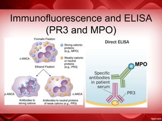 Immunofluorescence and ELISA
(PR3 and MPO)
MPO
 