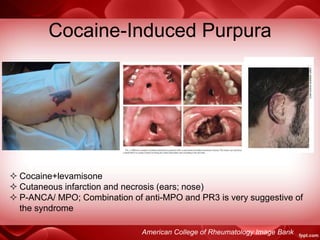 Cocaine-Induced Purpura
 Cocaine+levamisone
 Cutaneous infarction and necrosis (ears; nose)
 P-ANCA/ MPO; Combination of anti-MPO and PR3 is very suggestive of
the syndrome
American College of Rheumatology Image Bank
 