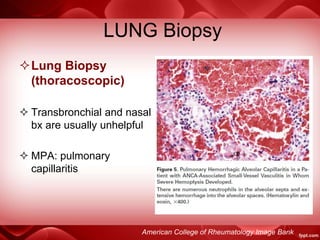 LUNG Biopsy
Lung Biopsy
(thoracoscopic)
 Transbronchial and nasal
bx are usually unhelpful
 MPA: pulmonary
capillaritis
American College of Rheumatology Image Bank
 