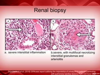 a. severe interstitial inflammation
Zagelbaum N et al. (2016) GPAcase report outlining the importance of urinalysis in patients presenting
with pulmonary cavitary lesions Pulm Crit Care Med
Renal biopsy
b.severe, with multifocal necrotizing
interstitial granulomas and
arteriolitis
 