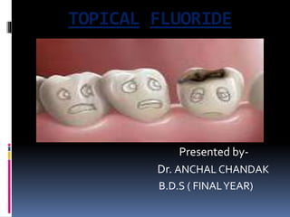 TOPICAL FLUORIDE
Presented by-
Dr. ANCHAL CHANDAK
B.D.S ( FINALYEAR)
 