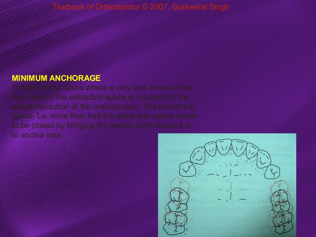 Anchorage in orthodontics
