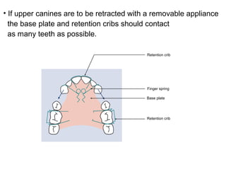 Retention crib
Retention crib
Base plate
Finger spring
• If upper canines are to be retracted with a removable appliance
the base plate and retention cribs should contact
as many teeth as possible.
 