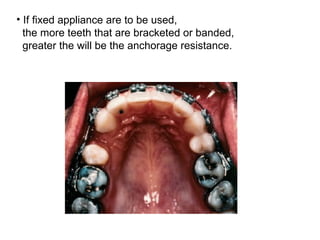 • If fixed appliance are to be used,
the more teeth that are bracketed or banded,
greater the will be the anchorage resistance.
 