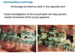 Intermaxillary anchorage
Anchorage provided by teeth in the opposite arch.
• Good interdigitation of the buccal teeth can help prevent
mesial movement of the buccal segment.
 