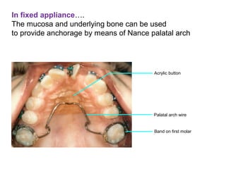 In fixed appliance….
The mucosa and underlying bone can be used
to provide anchorage by means of Nance palatal arch.
Band on first molar
Palatal arch wire
Acrylic button
 