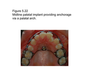 Figure 5.22
Midline palatal implant providing anchorage
via a palatal arch.
 