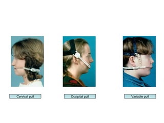 Cervical pull Occipital pull Variable pull
 
