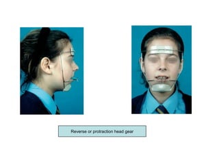 Reverse or protraction head gear
 