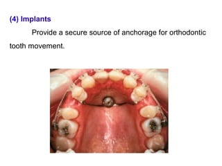 (4) Implants
Provide a secure source of anchorage for orthodontic
tooth movement.
 