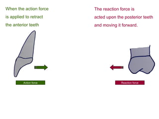 Action force Reaction force
The reaction force is
acted upon the posterior teeth
and moving it forward.
When the action force
is applied to retract
the anterior teeth
 