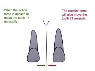 When the action
force is applied to
move the tooth 11
measially
The reaction force
will also move the
tooth 21 mesially.
 