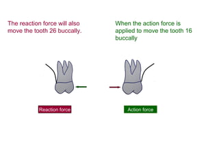 The reaction force will also
move the tooth 26 buccally.
Action forceReaction force
When the action force is
applied to move the tooth 16
buccally
 