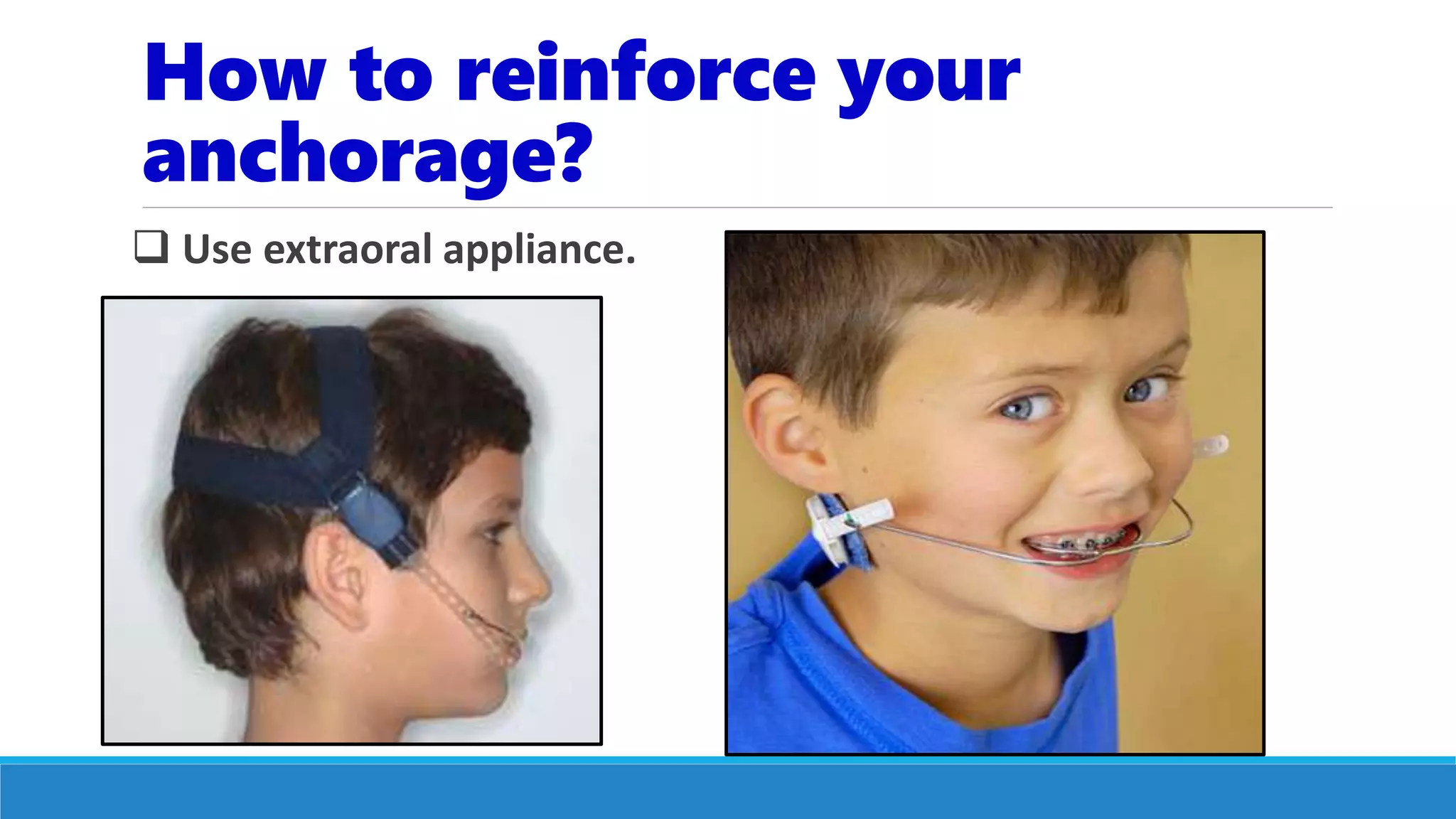 Anchorage in Orthodontic | PPTX
